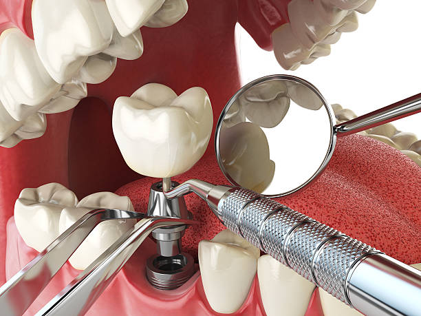 Best Emergency Tooth Extraction in Fort Benton, MT
